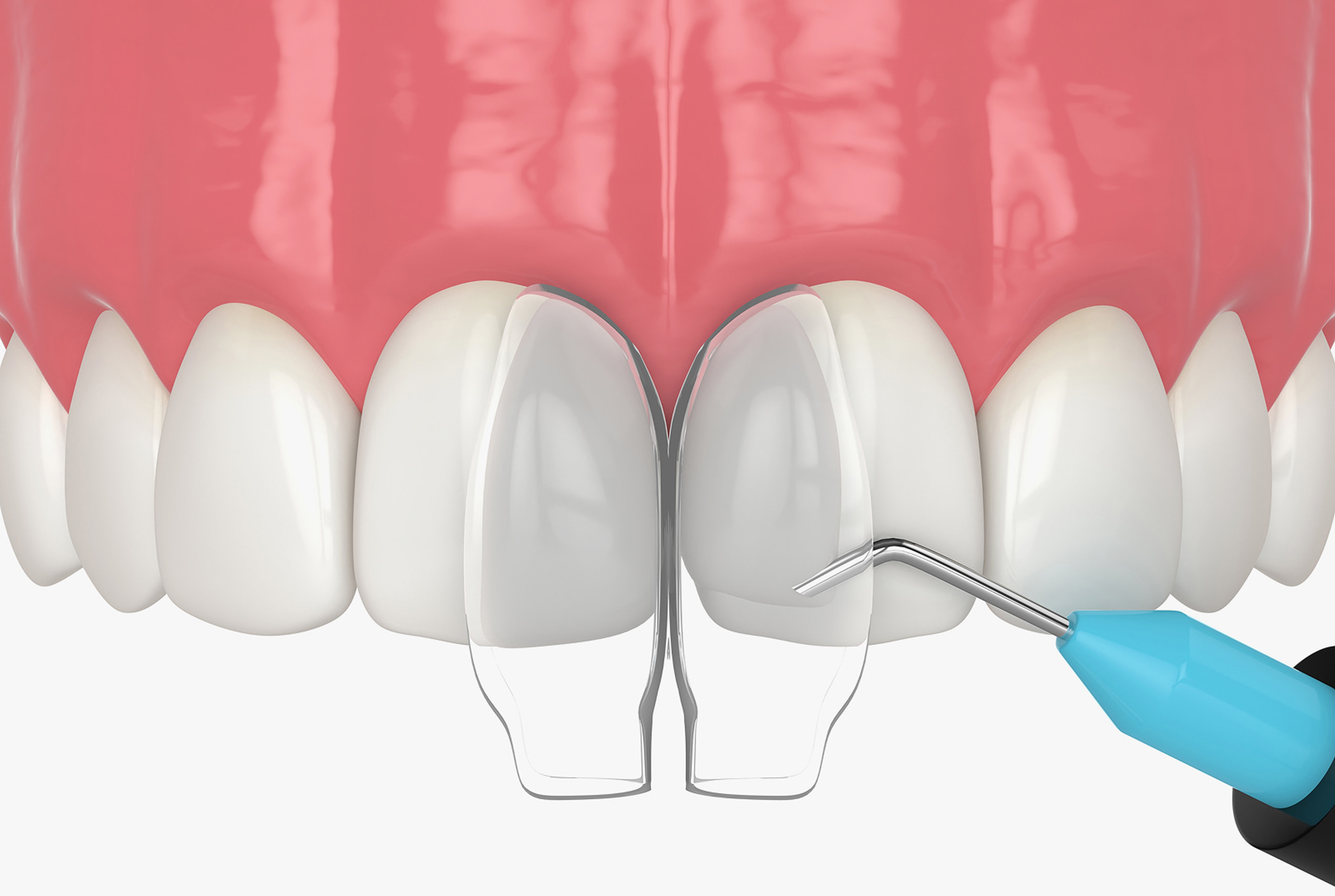 What Is Dental Bonding?