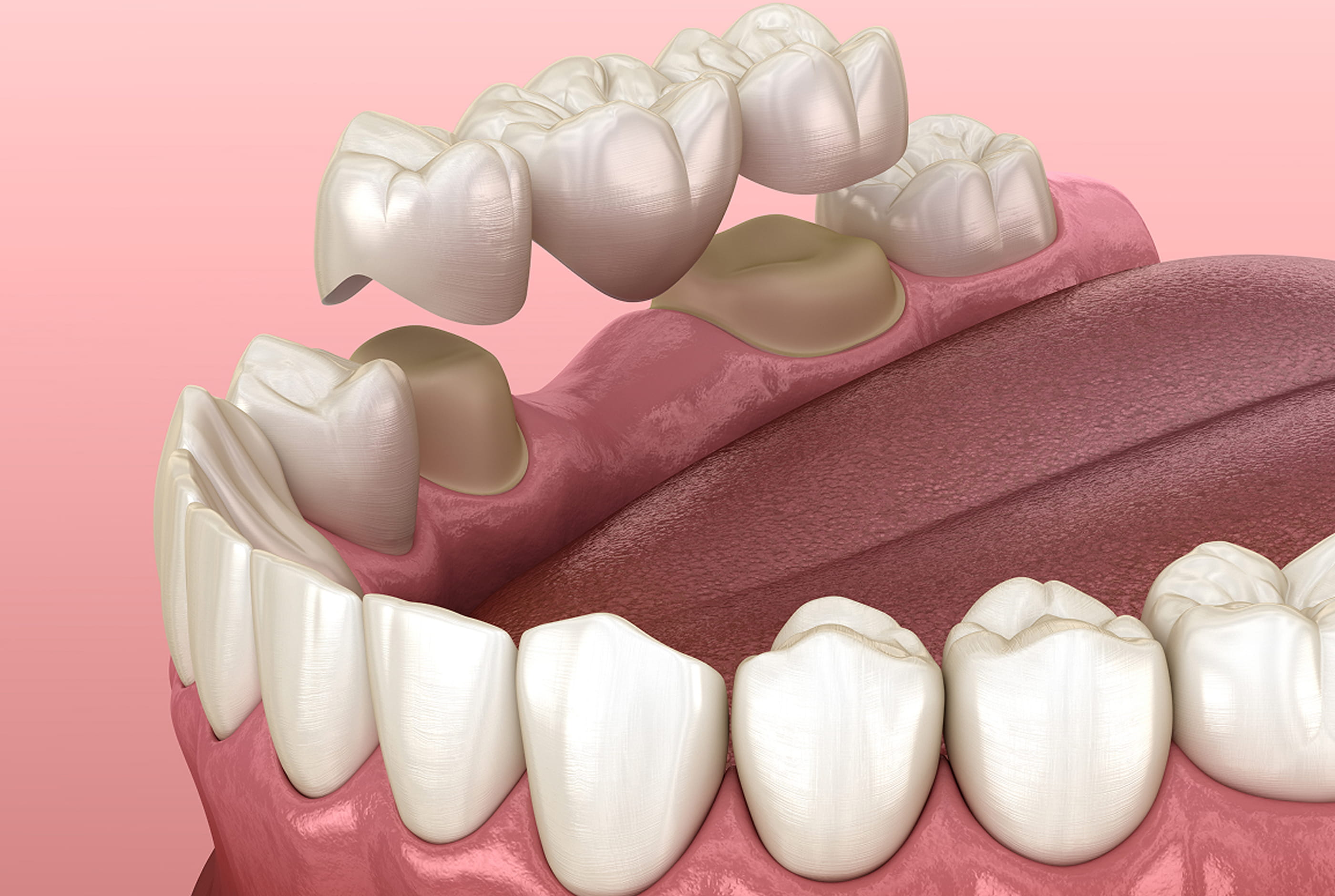 What Are Dental Crowns?