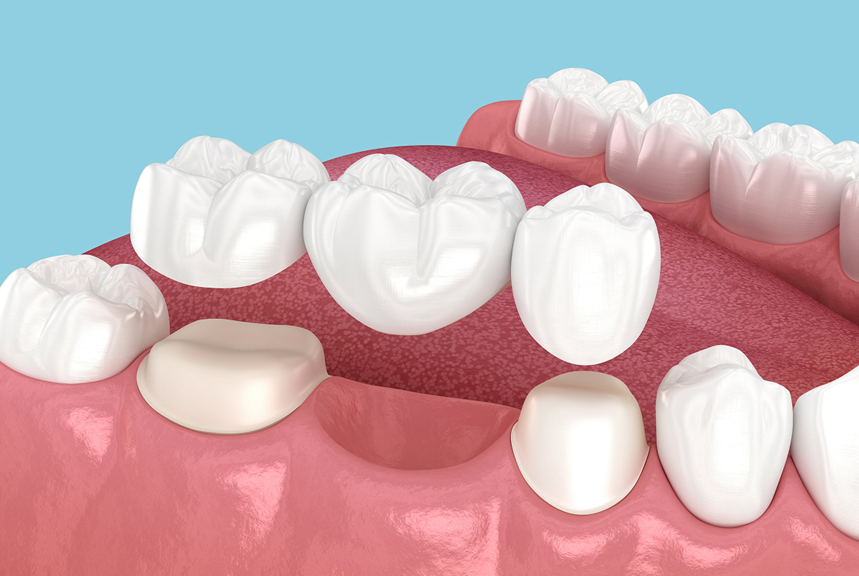 Caring for Crowns and Bridges