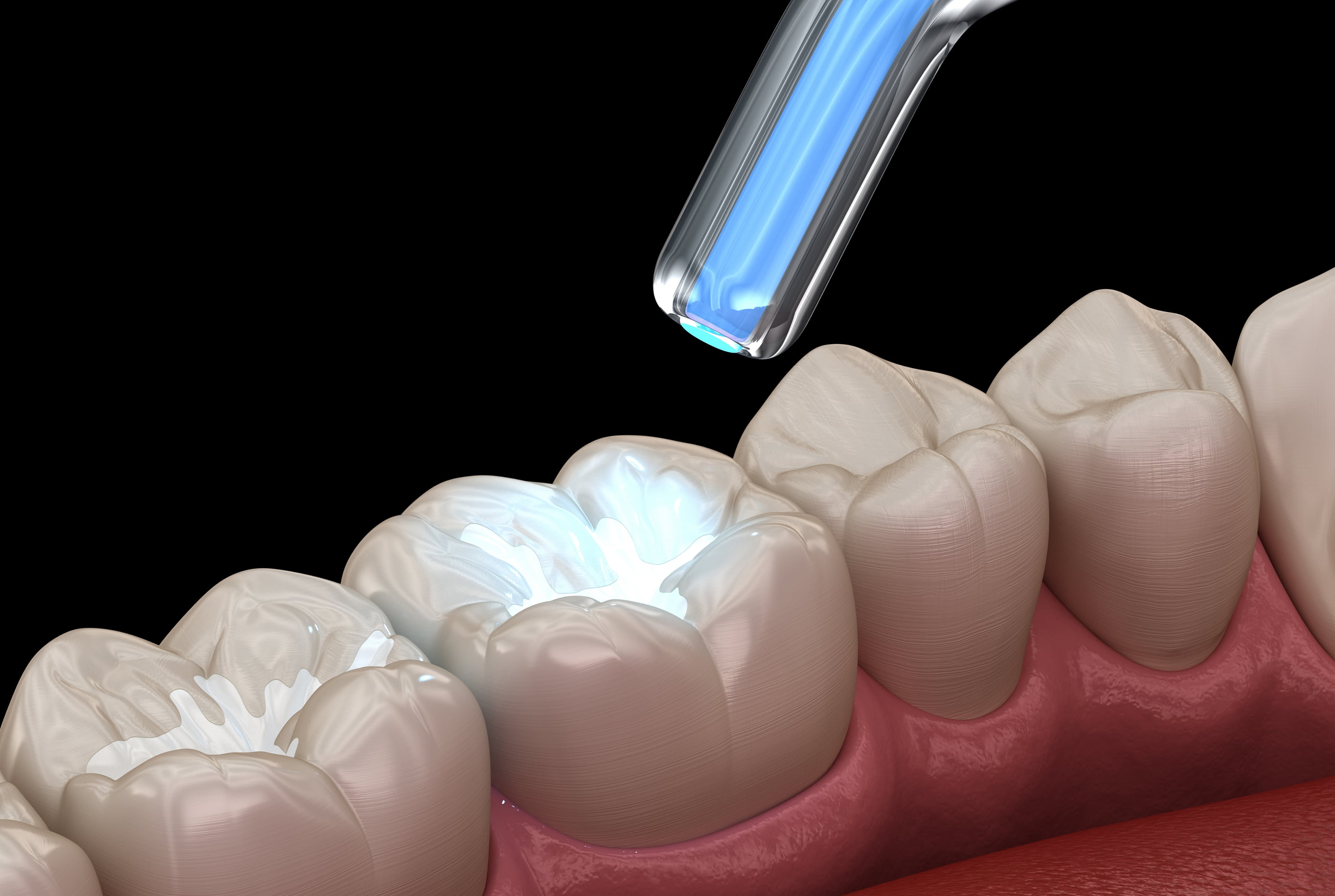 What Are Dental Fillings?