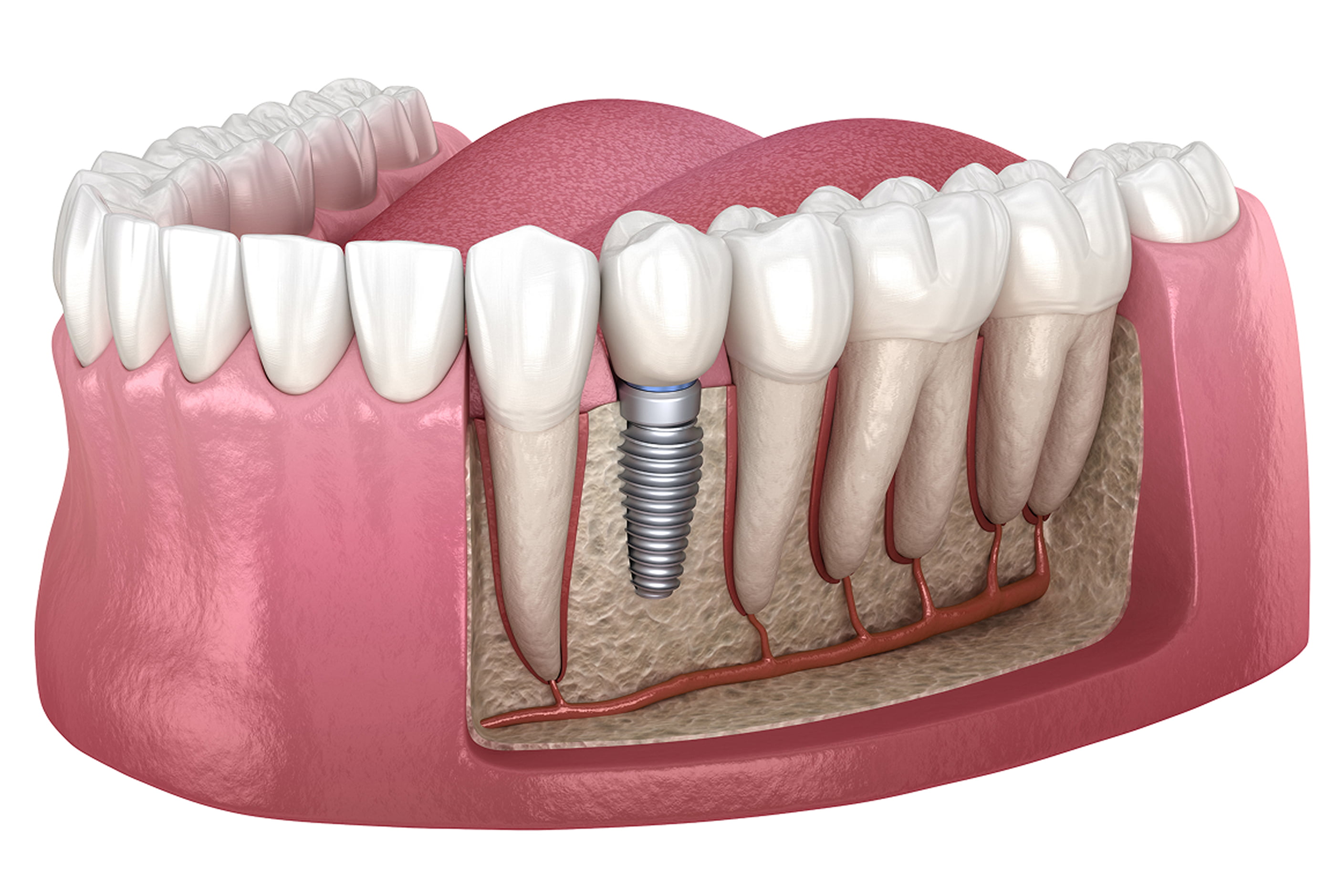 Single Tooth Implants