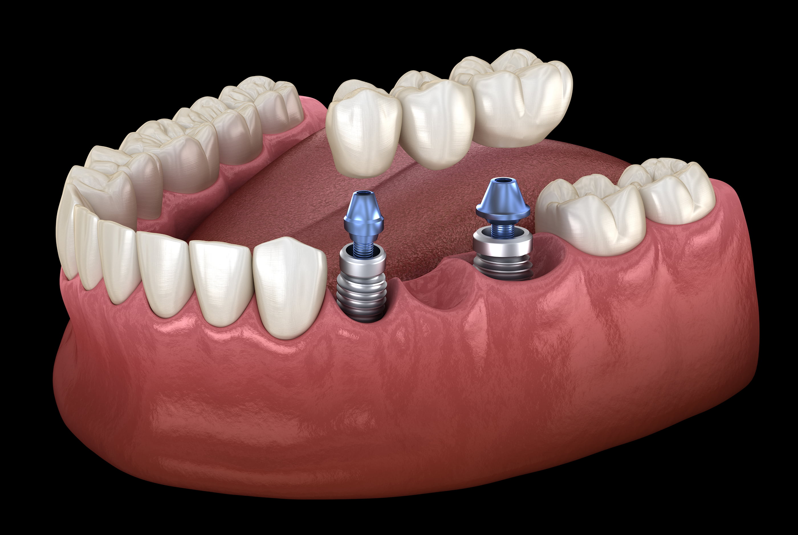 Implant-Supported Bridges