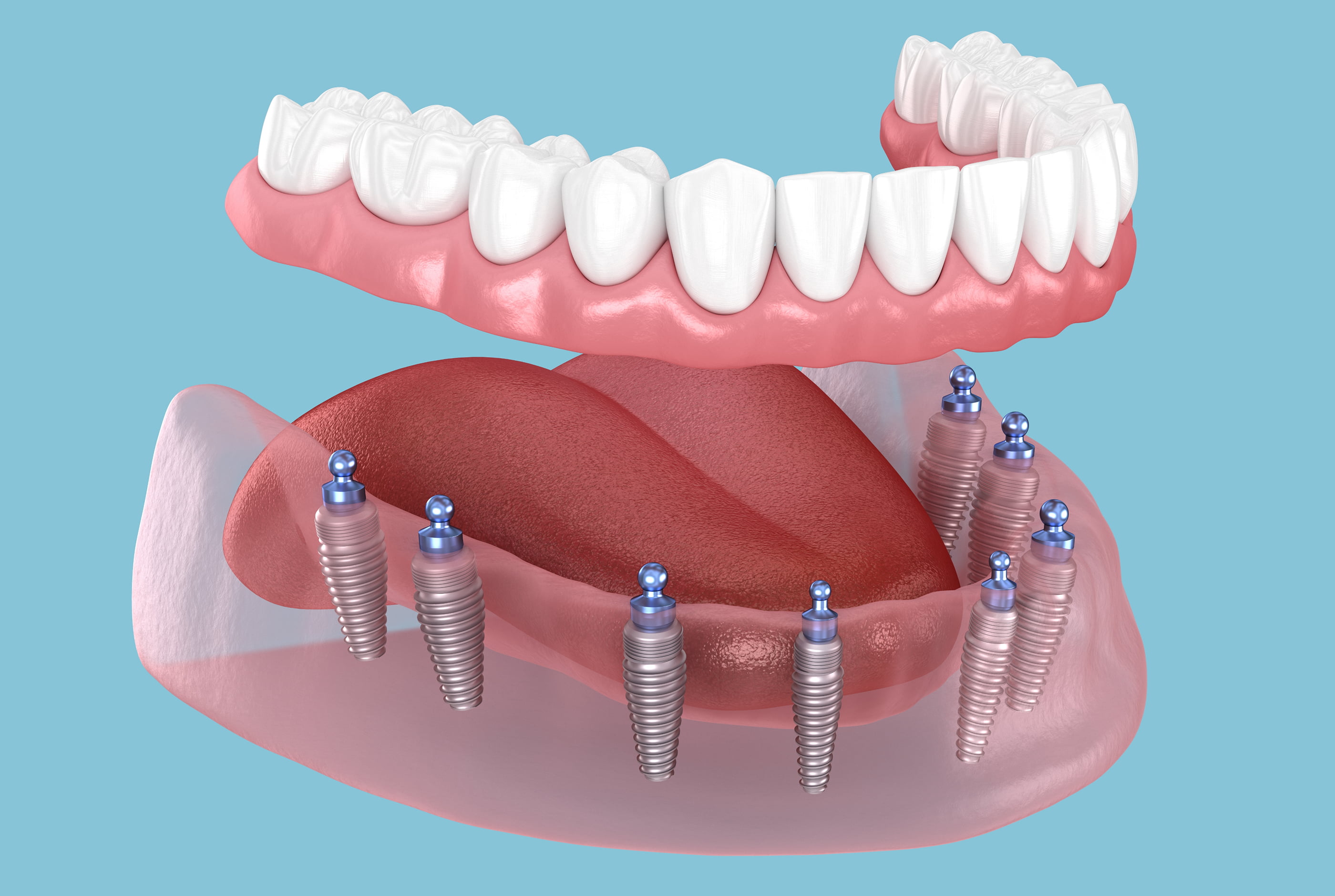 Implant-Supported Dentures