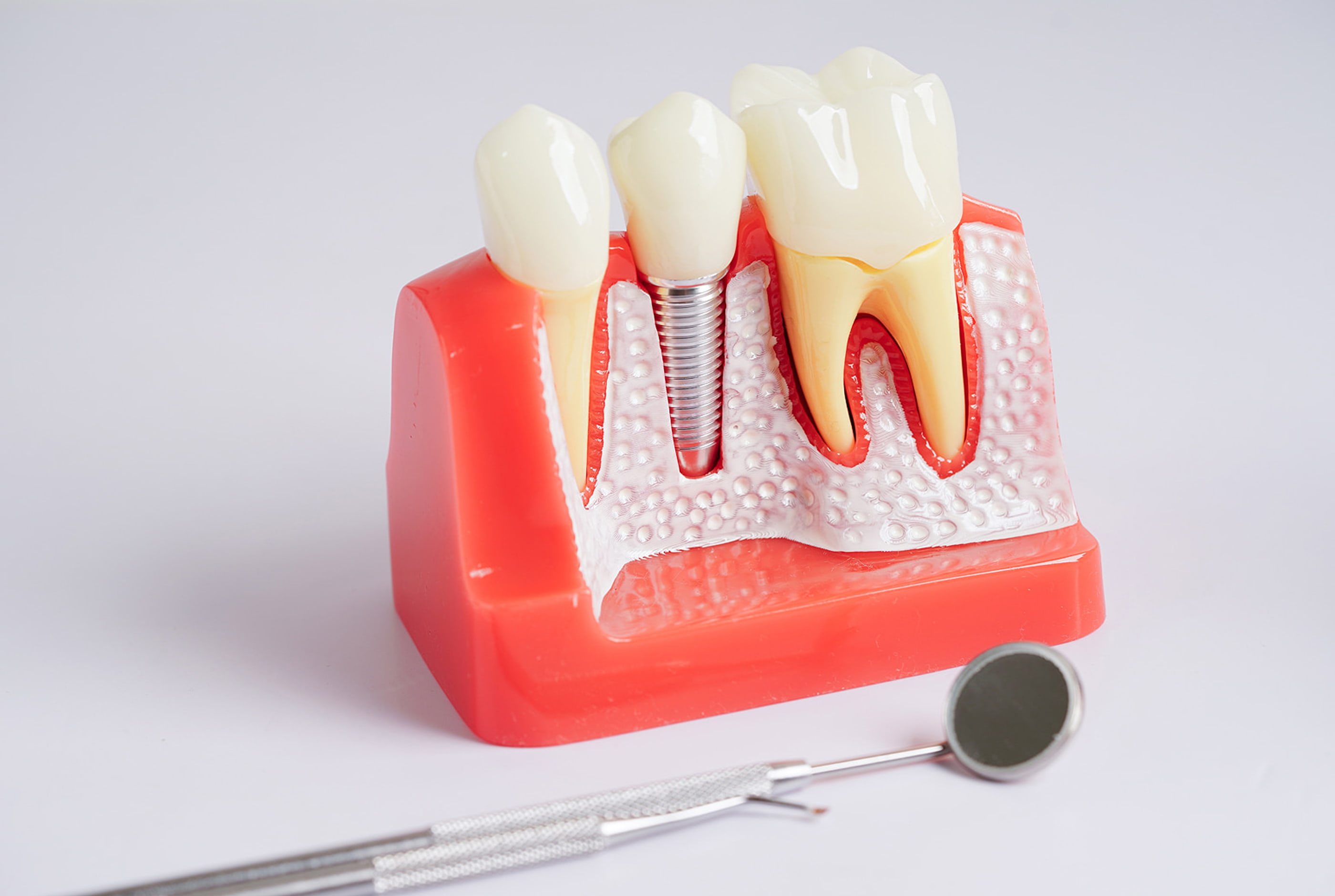 Benefits of Dental Implants
