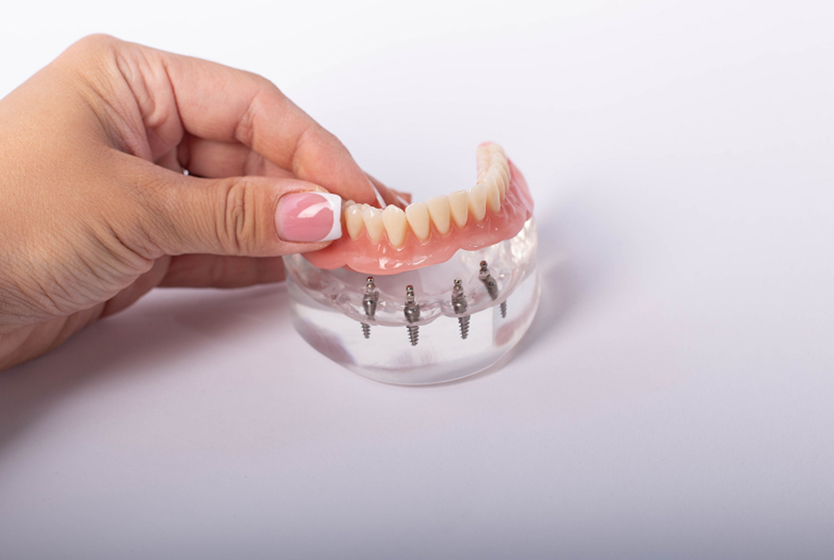 Removable Implant-Supported Dentures