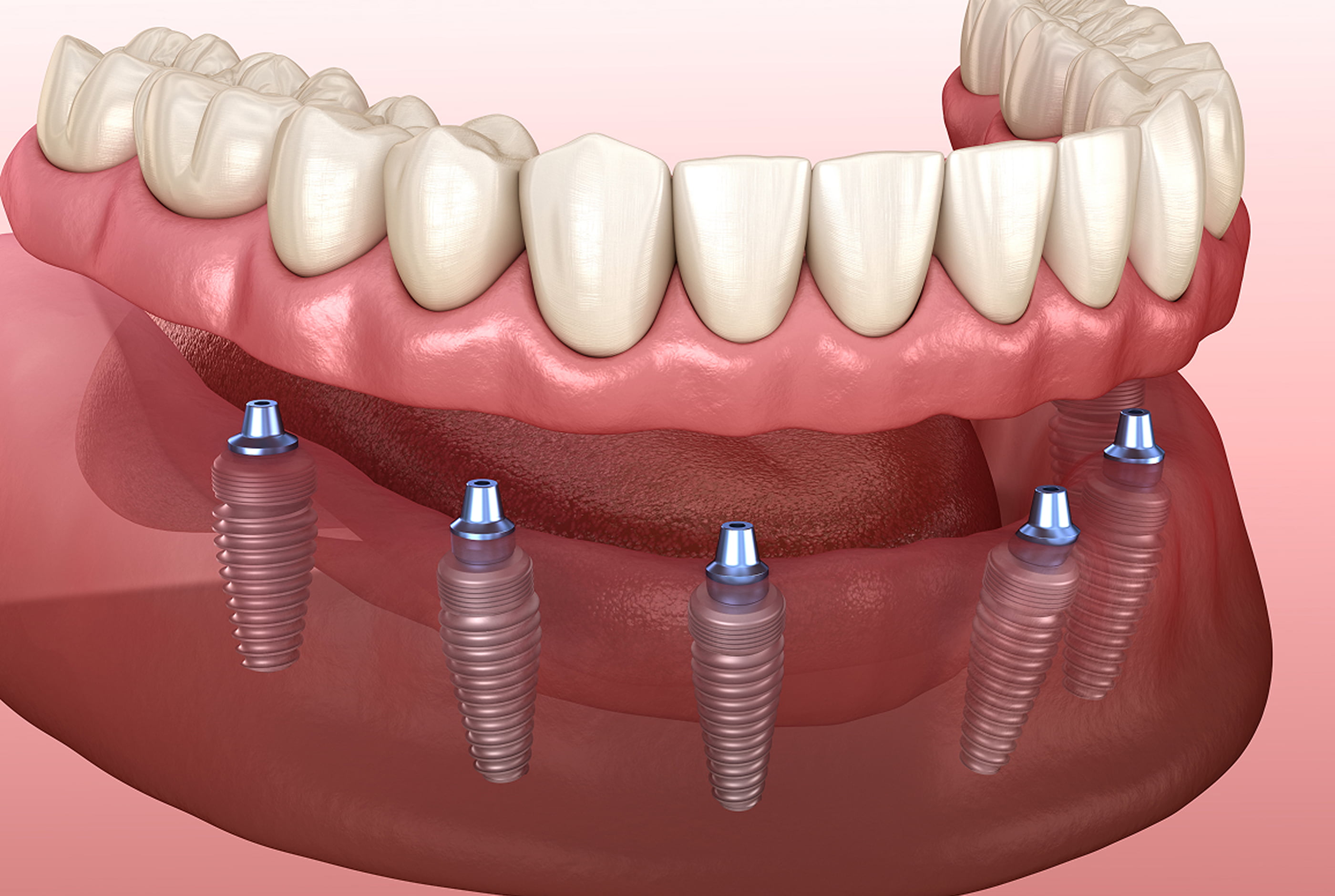 Benefits of implant-supported dentures for stability, comfort, and confidence.
