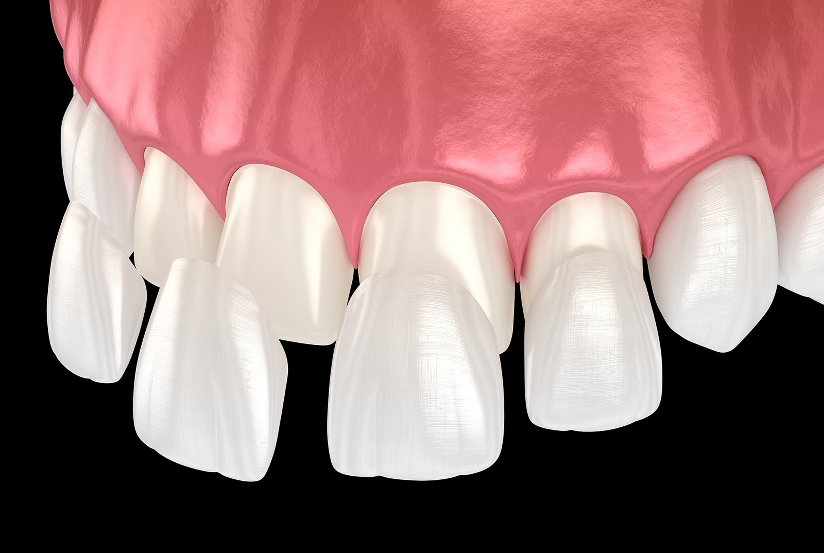 What Are Porcelain Veneers?