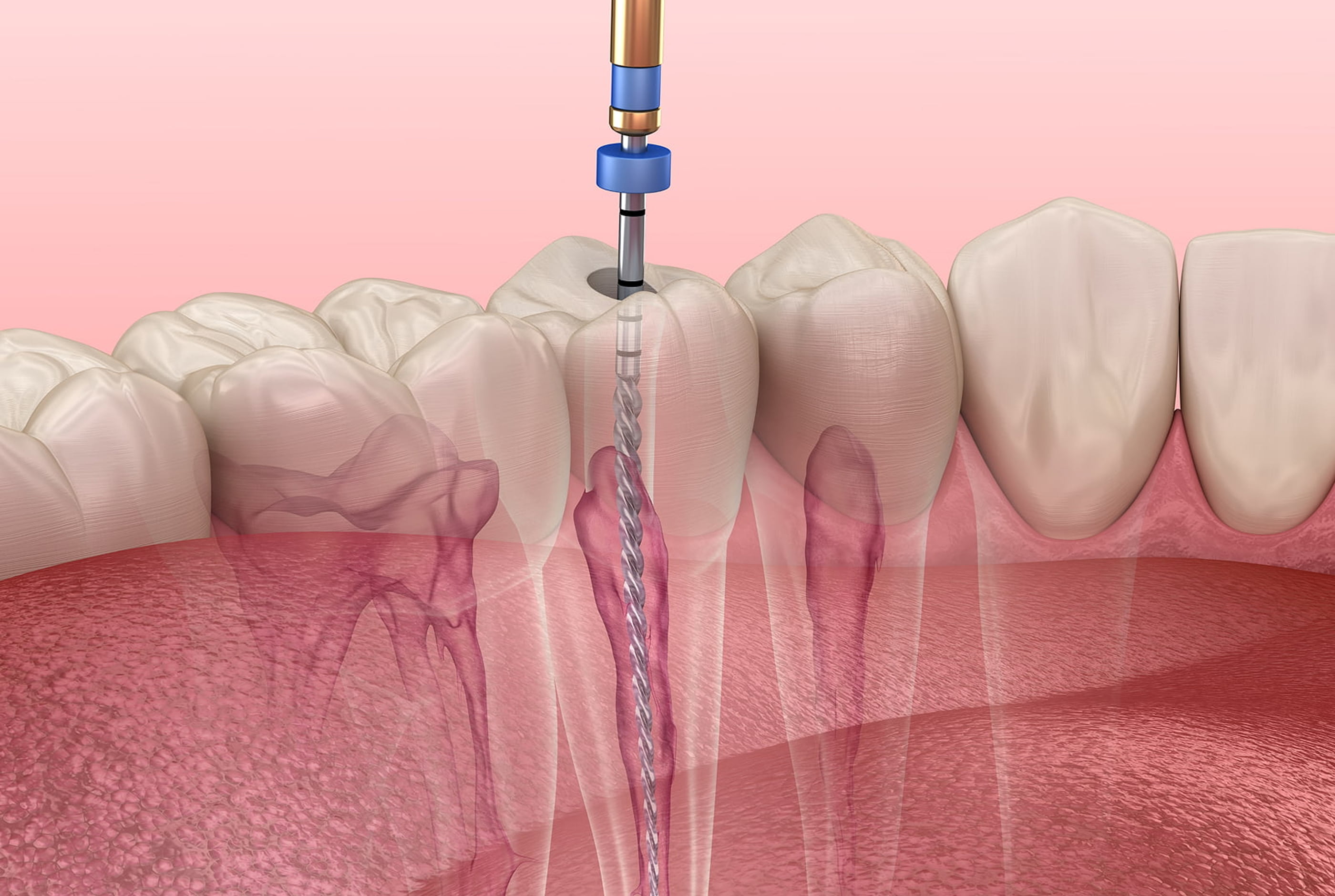 Comfortable root canal procedure with cleaning, sealing, and restoration of the tooth.