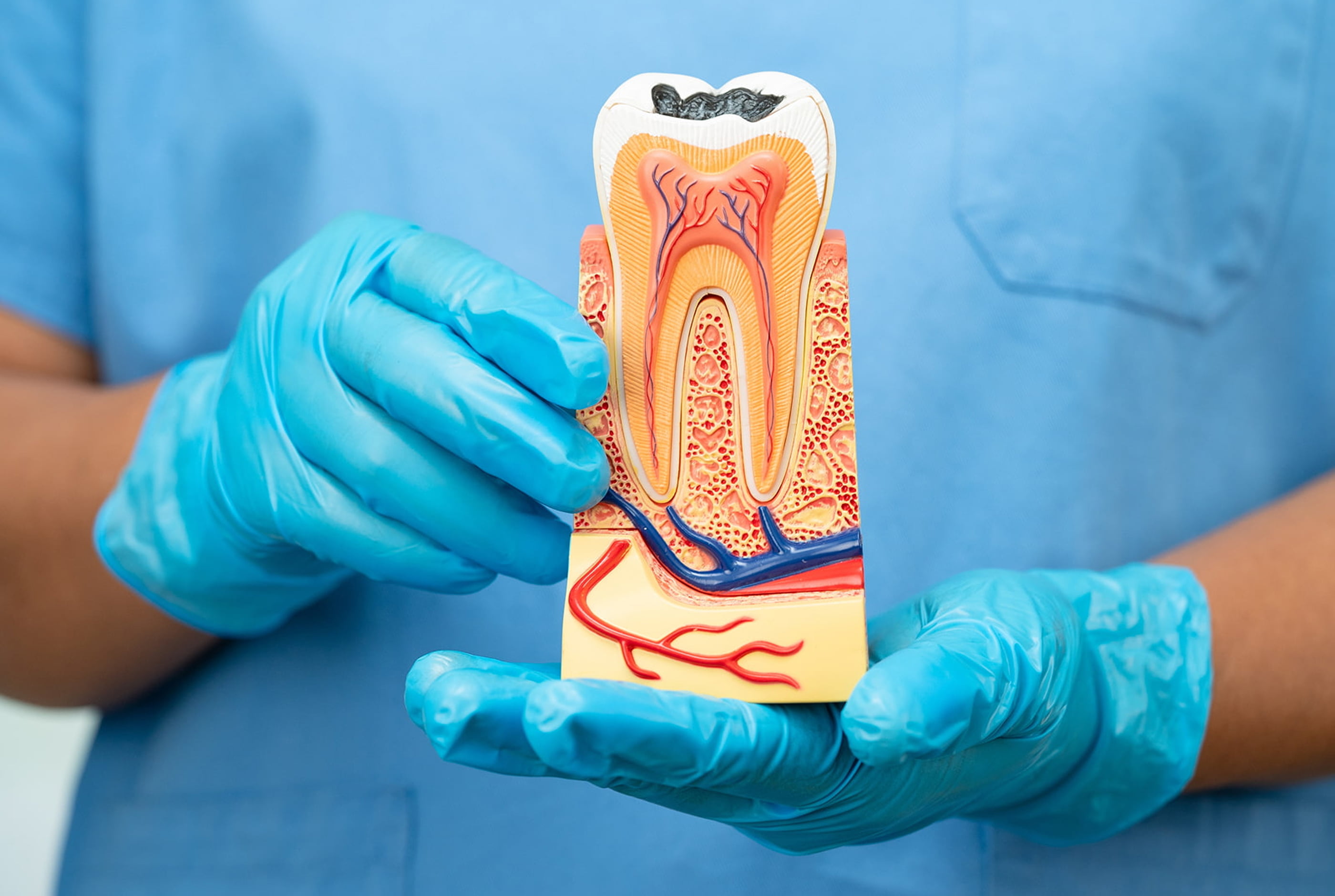Dental crown placed after root canal to protect and strengthen the tooth.