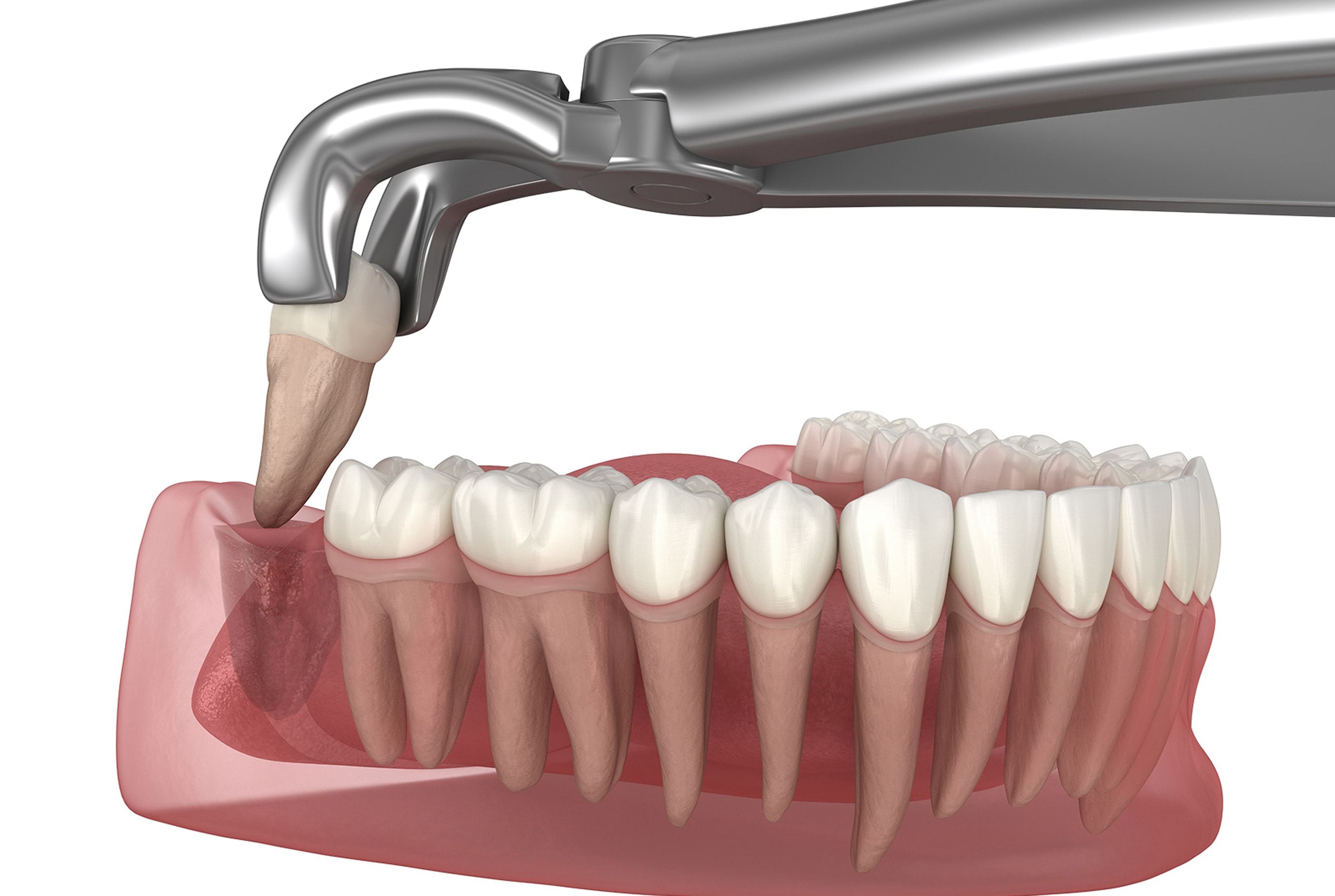 Tooth replacement options after extraction.
