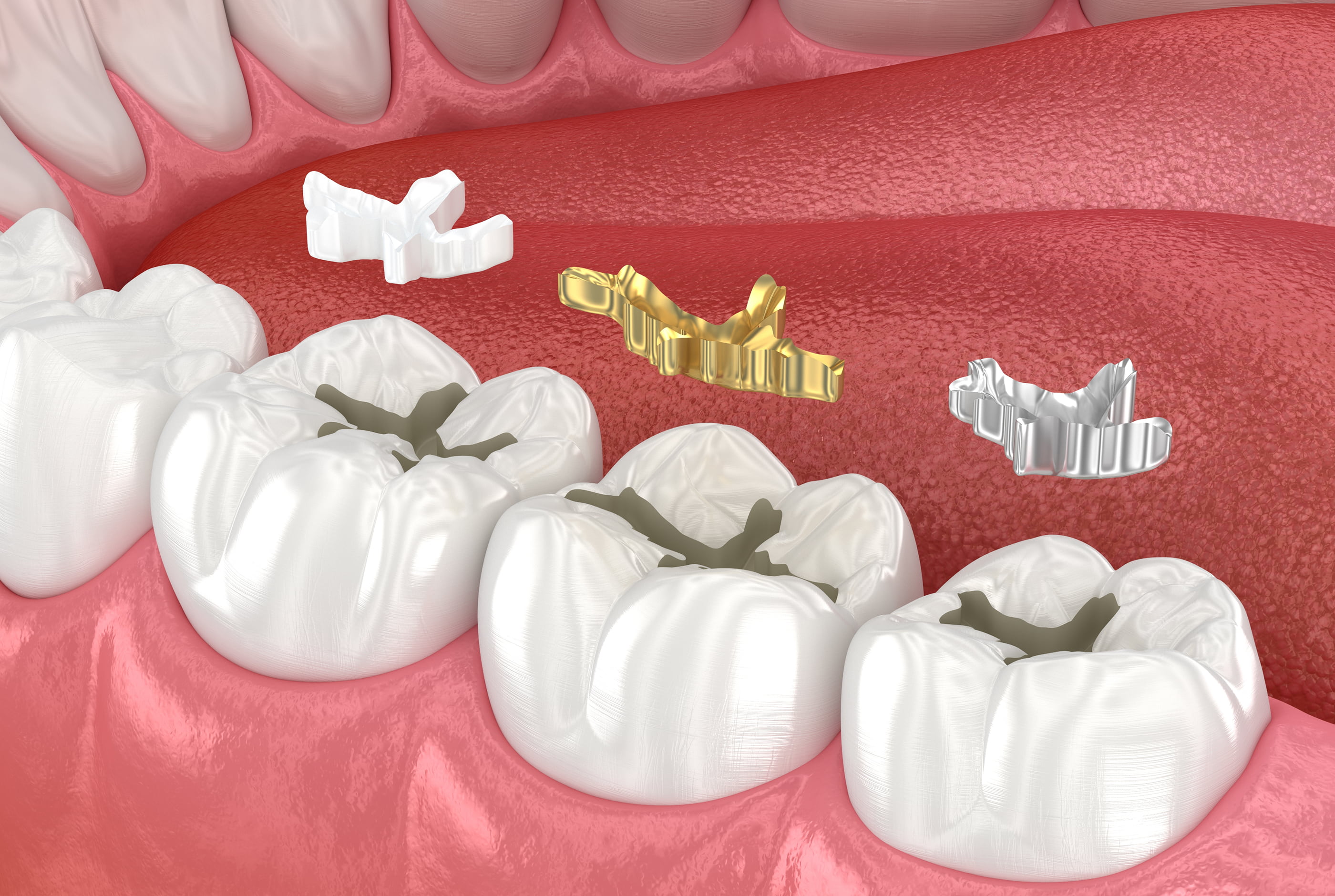 Dental Fillings
