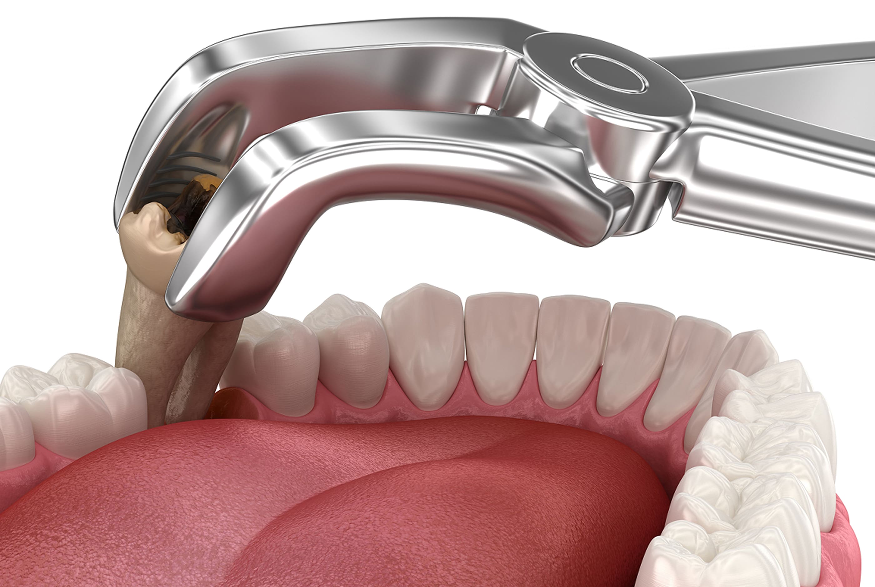 Tooth Extractions