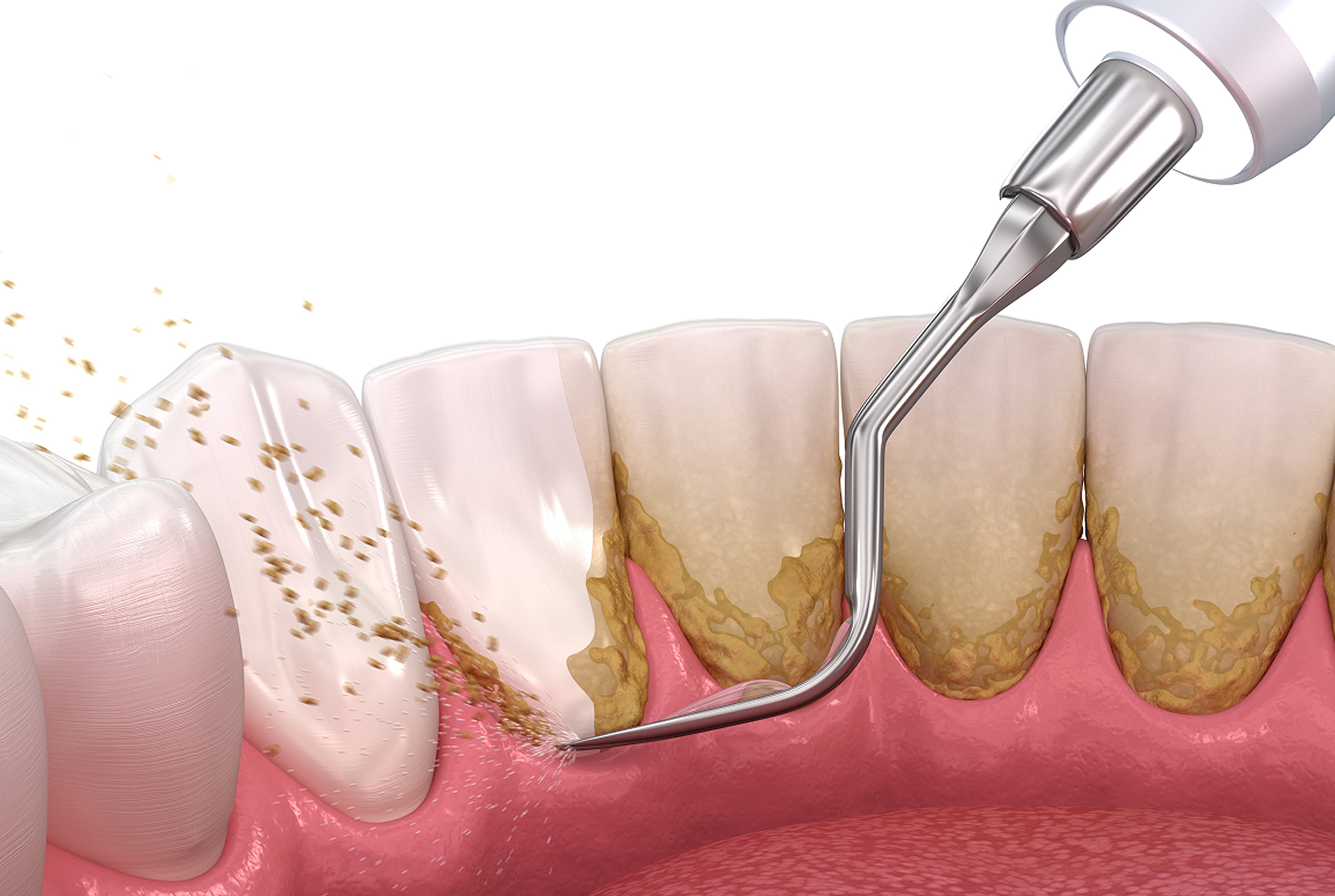Periodontal Treatment