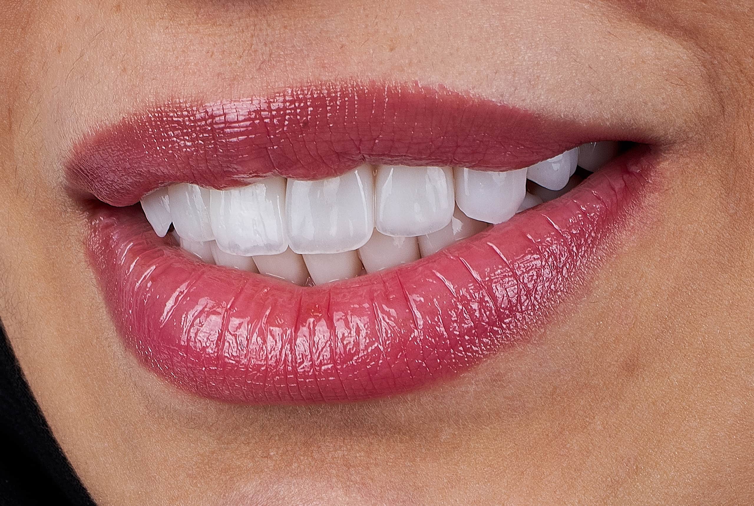 How Long Does Dental Bonding Last?