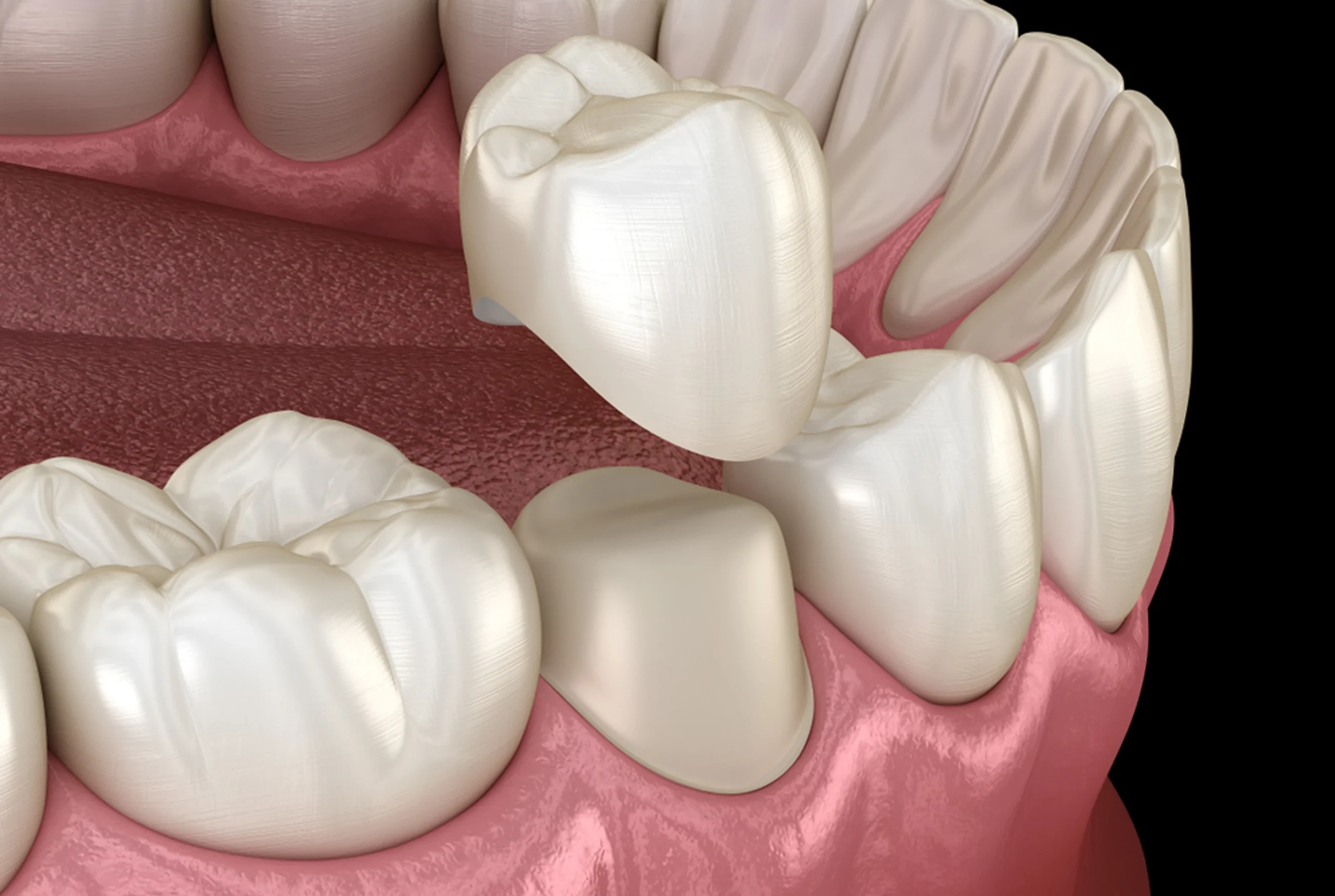 Dental Crowns