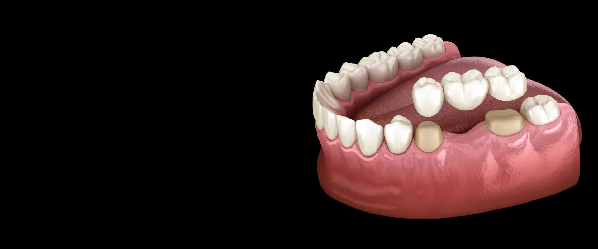 Dental Crowns & Bridges