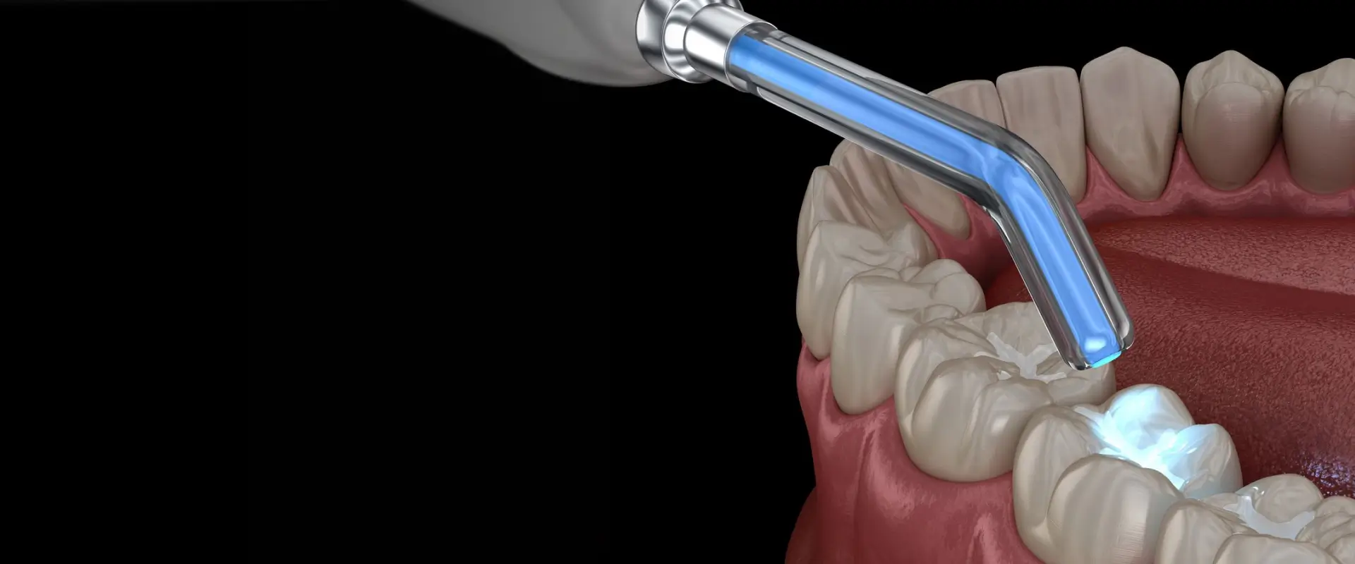Dental Fillings