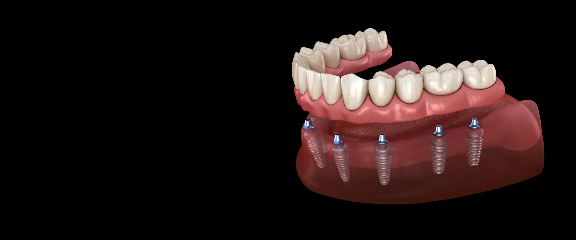 Implant-Supported Dentures