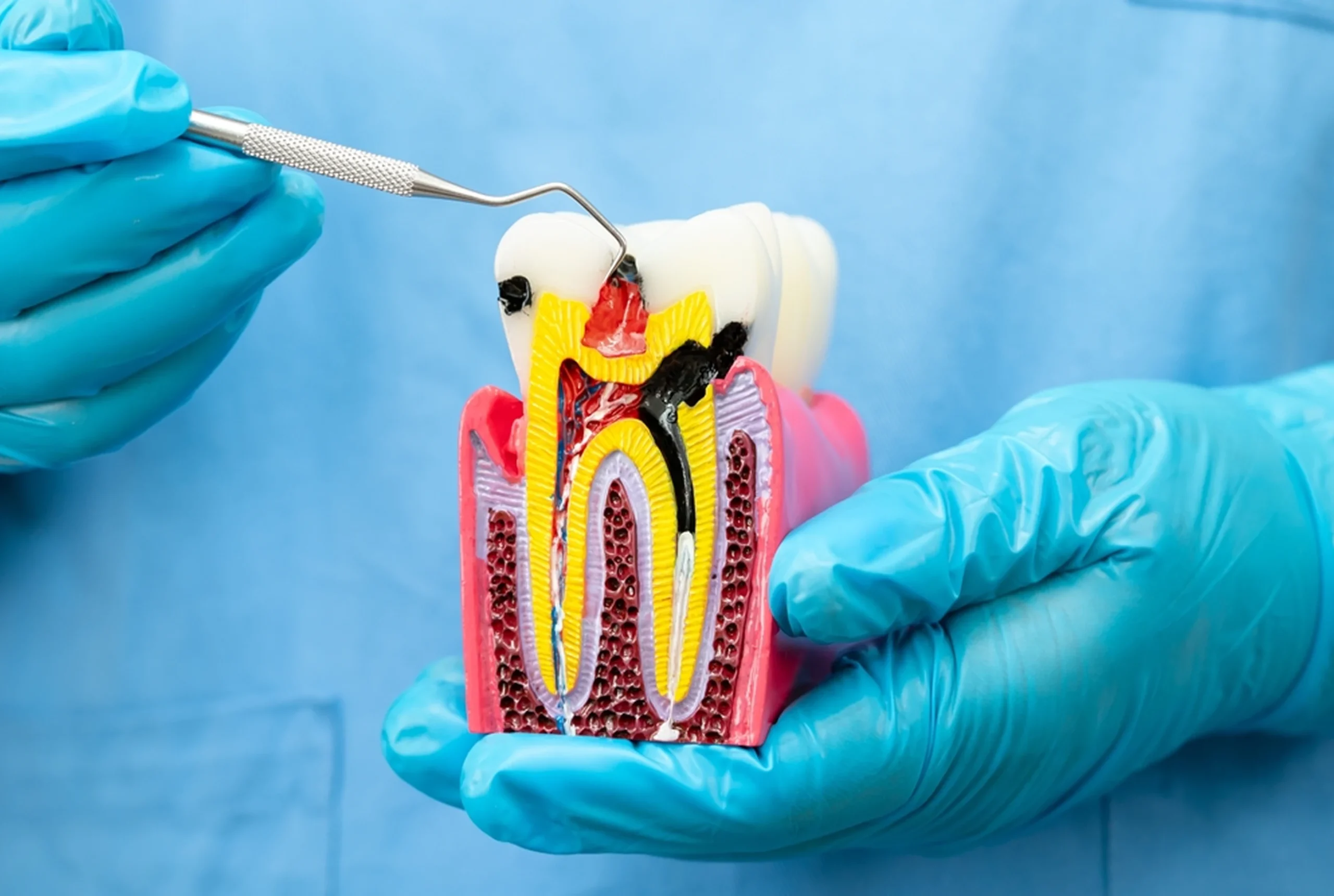 Root Canal Therapy