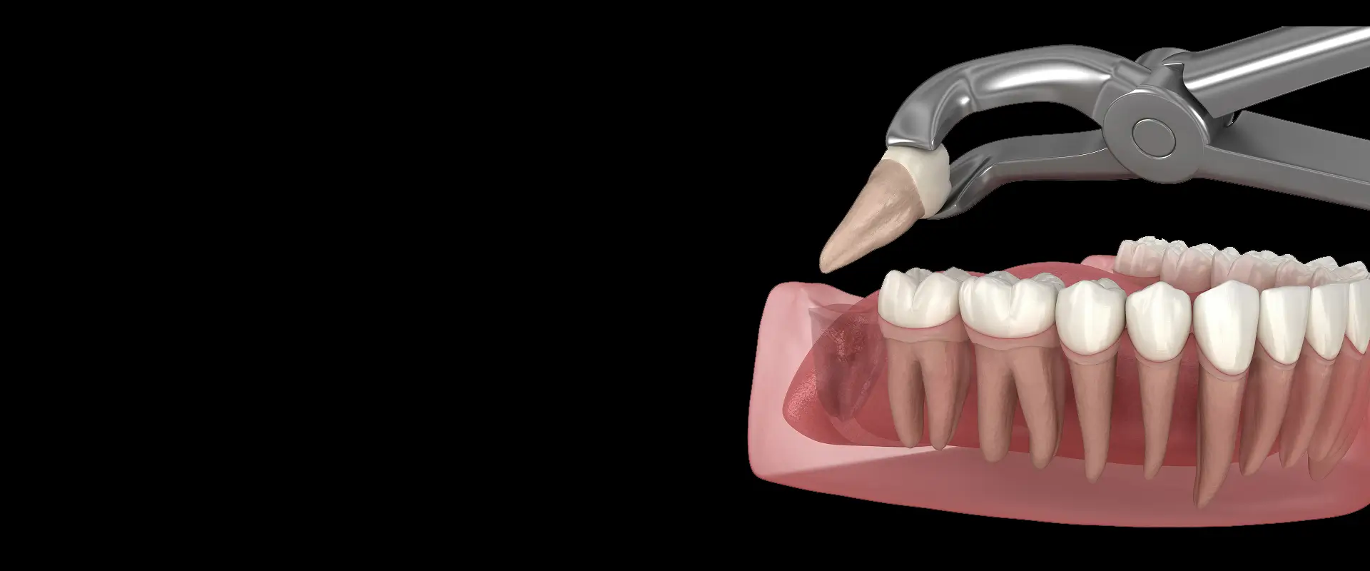Tooth Extractions
